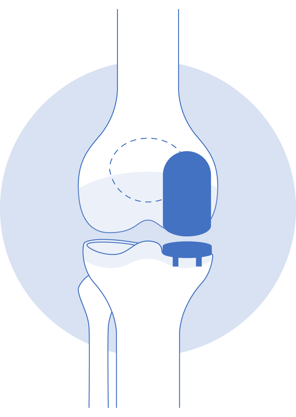 Knee replacement partial icon